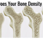 Perimenopause Osteoporosis – Are You At Risk?