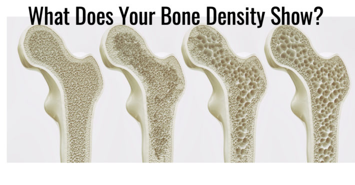 Perimenopause Osteoporosis – Are You At Risk?