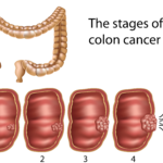 Music Monday: Colon Cancer Song – Light At The End of Your Tunnel