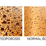 What Every Woman Should Know About Osteoporosis