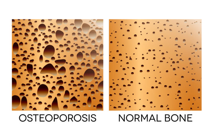 What Every Woman Should Know About Osteoporosis